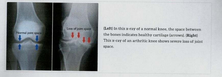 Arthritis of the Knee: Symptoms, Non-Surgical and Surgical Treatment in Dubai Arthritis of the Knee: Symptoms, Non-Surgical and Surgical Treatment in Dubai